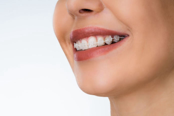 Tooth Colored Child Braces in Albuquerque
